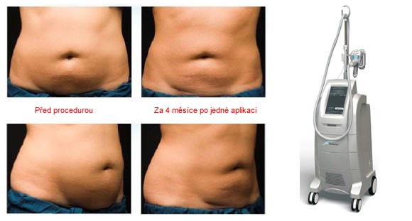 Kryolipolýza